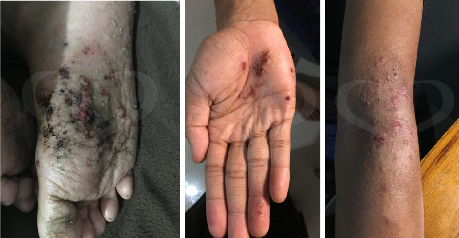 Kondisi awal pasien palmo-plantar pustula psoriasis